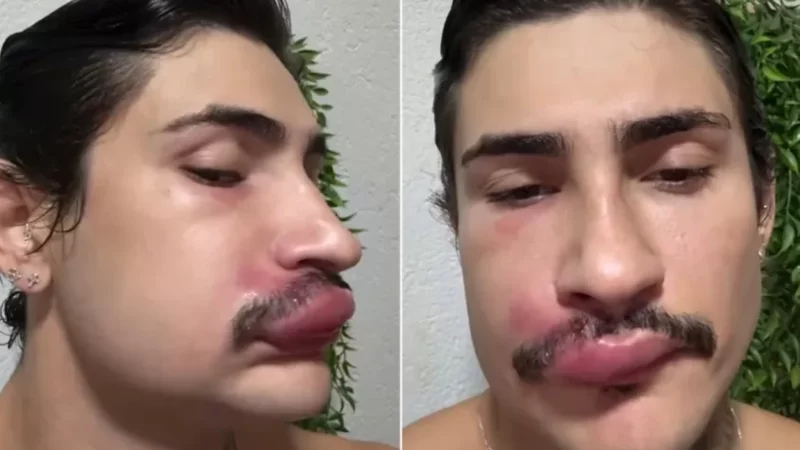 Influencer da Capital fica com rosto deformado e acaba internado ao espremer espinha