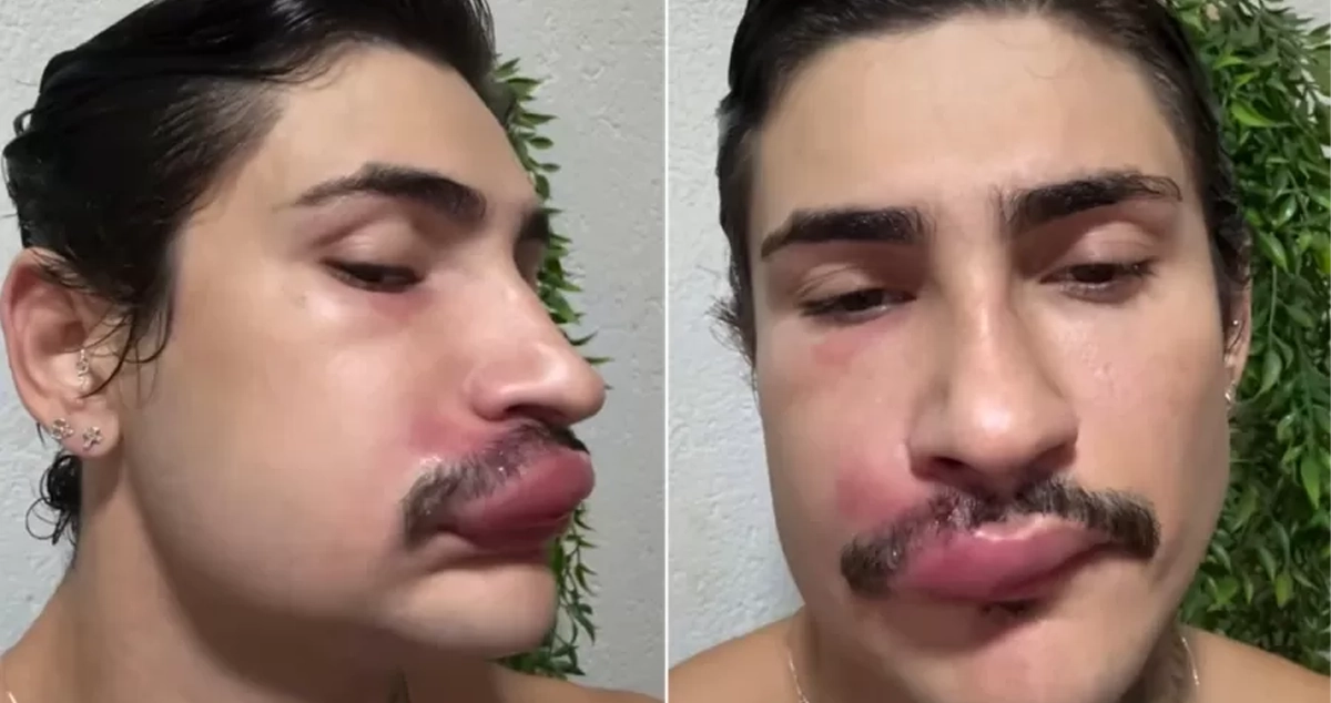 Influencer da Capital fica com rosto deformado e acaba internado ao espremer espinha